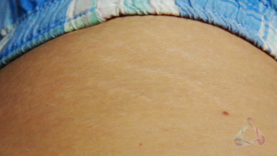 How to prevent stretchmarks in pregnancy