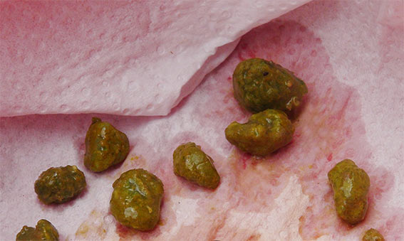 Liver-cleanse-gallstones